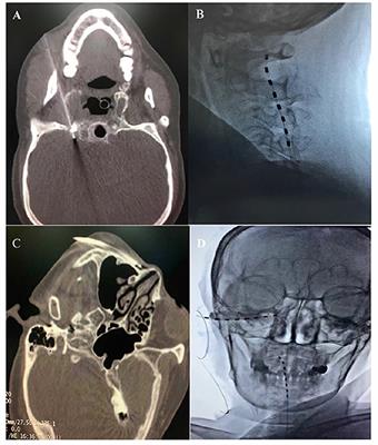 Case Report: Short-Term Spinal Cord Stimulation and Peripheral Nerve Stimulation for the Treatment of Trigeminal Postherpetic Neuralgia in Elderly Patients